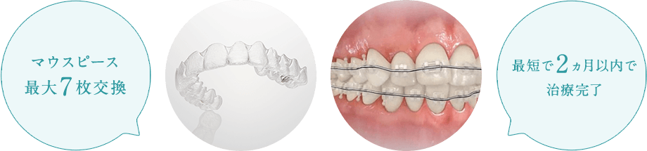 マウスピース最大7枚交換 最短で2ヵ月以内で治療完了