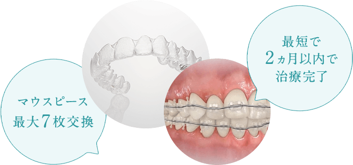 マウスピース最大7枚交換 最短で2ヵ月以内で治療完了
