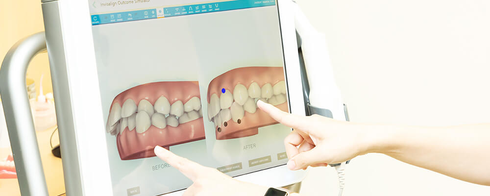 最新のスキャナーiTeroで治療後のシュミレーション画像が確認できます