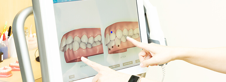 最新のスキャナーiTeroで治療後のシュミレーション画像が確認できます